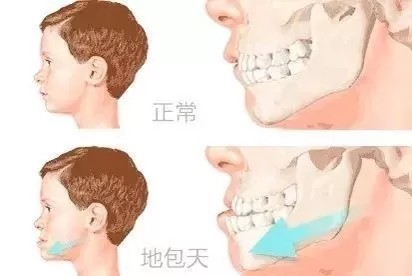 地包天矫正几岁做最好