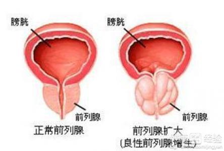 前列腺肥大吃什么药效果好见效快些