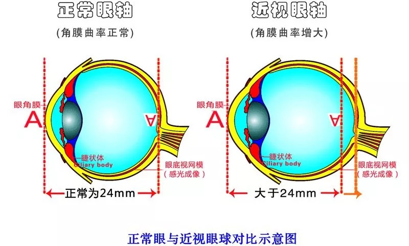 眼睛近视可以治吗