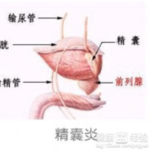 精囊炎有什么症状和危害性