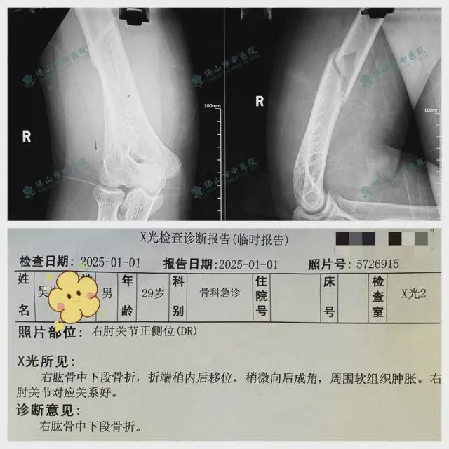 两小伙与机器人扳手腕当场骨折